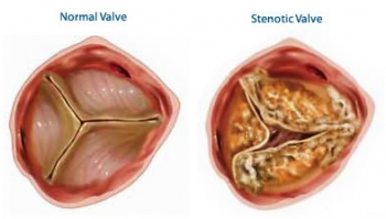 Heart Valve